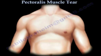 Pectoralis Muscle ,tendon Tear  Everything You Need To Know  Dr. Nabil Ebraheim