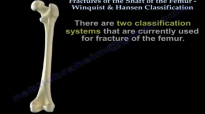 Fractures Of The Femur Shaft Winquist & Hansen  Everything You Need To Know  Dr. Nabil Ebraheim