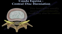 Cauda Equina, Central Disc Herniation  Everything You Need To Know  Dr. Nabil Ebraheim