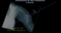 NONUNION Of The Humerus Classic  Everything You Need To Know  Dr. Nabil Ebraheim