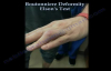 Boutonniere Deformity Elsons Test  Everything You Need To Know  Dr. Nabil Ebraheim