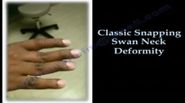 Swan Neck Deformity, Classic Snapping  Everything You Need To Know  Dr. Nabil Ebraheim