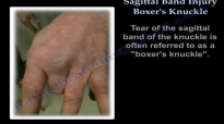 Sagittal Band Injury Boxers Knuckle  Everything You Need To Know  Dr. Nabil Ebraheim
