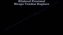 Bilateral Proximal Biceps Tendon Rupture  Everything You Need To Know  Dr. Nabil Ebraheim