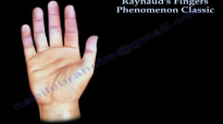 Raynauds Fingers Phenomenon classic  Everything You Need To Know  Dr. Nabil Ebraheim