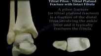 Tibial Pilon Fracture With Intact Fibula  Everything You Need To Know  Dr. Nabil Ebraheim
