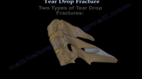 Tear Drop Fracture of the cervical spine  Everything You Need To Know  Dr. Nabil Ebraheim