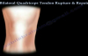 Bilateral Quadriceps Tendon Rupture & Repair  Everything You Need To Know  Dr. Nabil Ebraheim