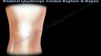 Bilateral Quadriceps Tendon Rupture & Repair  Everything You Need To Know  Dr. Nabil Ebraheim