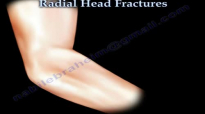 Radial Head Fracture Everything You Need To Know Dr. Nabil Ebraheim