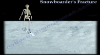 TALUS FRACTURE ,SNOWBOARDERS injury Everything You Need To Know  Dr. Nabil Ebraheim
