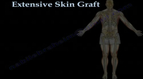 Skin Graft ,major  Part II. Everything You Need To Know  Dr. Nabil Ebraheim