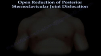 Posterior Sternoclavicular Dislocation reduction.  Everything You Need To Know  Dr. Nabil Ebraheim