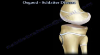 Osgood Schlatter Disease  Everything You Need To Know  Dr. Nabil Ebraheim