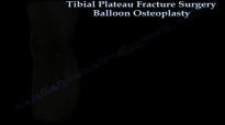 Tibial Plateau Fracture Balloon Osteoplasty  Everything You Need To Know  Dr. Nabil Ebraheim