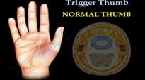 Trigger Thumb  Everything You Need To Know  Dr. Nabil Ebraheim