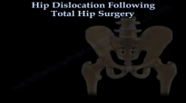 Hip Dislocation Following Total Hip replacement  Everything You Need To Know  Dr. Nabil Ebraheim
