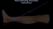 Necrotizing Fasciitis Infection  Everything You Need To Know  Dr. Nabil Ebraheim