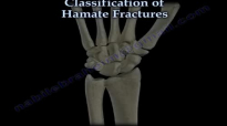 Hamate Fractures  Everything You Need To Know  Dr. Nabil Ebraheim