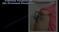 External Fixation Of The Proximal Humerus  Everything You Need To Know  Dr. Nabil Ebraheim