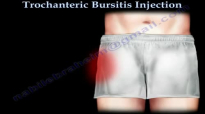 Trochanteric Bursitis Injection  Everything You Need To Know  Dr. Nabil Ebraheim