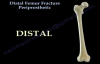 Distal Femur Fracture Periprosthetic  Everything You Need To Know  Dr. Nabil Ebraheim