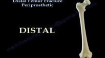 Distal Femur Fracture Periprosthetic  Everything You Need To Know  Dr. Nabil Ebraheim