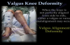 Valgus Knee Deformity  Everything You Need To Know  Dr. Nabil Ebraheim