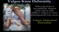 Valgus Knee Deformity  Everything You Need To Know  Dr. Nabil Ebraheim