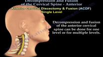 Cervical Spine ,Decompression And Fusion .  Everything You Need To Know  Dr. Nabil Ebraheim