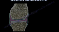 Rheumatoid Arthritis of the hand  Everything You Need To Know  Dr. Nabil Ebraheim
