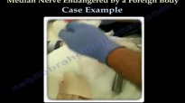 Median nerve at risk by a foreign body .Case Example . Dr. Nabil Ebraheim