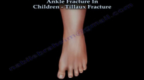Ankle Fracture In Children Tillaux Fracture  Everything You Need To Know  Dr. Nabil Ebraheim