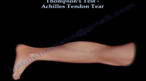 Thompsons Test Achilles Tendon Tear  Everything You Need To Know  Dr. Nabil Ebraheim