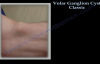 Volar Ganglion Cyst Classic  Everything You Need To Know  Dr. Nabil Ebraheim