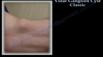 Volar Ganglion Cyst Classic  Everything You Need To Know  Dr. Nabil Ebraheim