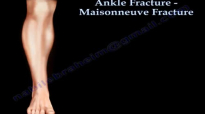 Ankle Fracture Maisonneuve Fracture  Everything You Need To Know  Dr. Nabil Ebraheim