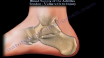 Achilles Tendon rupture , Vulnerablity to Injury  Everything You Need To Know  Dr. Nabil Ebraheim