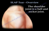 SLAP Tear Overview  Everything You Need To Know  Dr. Nabil Ebraheim
