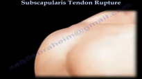 Subscapularis Tendon Rupture  Everything You Need To Know  Dr. Nabil Ebraheim