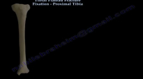 Tibial Plateau Fracture Fixation, Proximal Tibia  Everything You Need To Know  Dr. Nabil Ebraheim