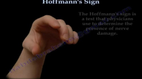 Hoffmanns Sign  Everything You Need To Know  Dr. Nabil Ebraheim