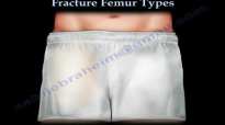 Fracture Femur Types  Everything You Need To Know  Dr. Nabil Ebraheim