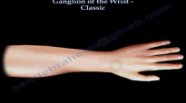 Ganglion Of The Wrist Classic  Everything You Need To Know  Dr. Nabil Ebraheim