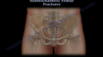 Subtrochanteric Femur Fractures  Everything You Need To Know  Dr. Nabil Ebraheim