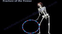 Fracture of the Femur and its fixation  Everything You Need To Know  Dr. Nabil Ebraheim