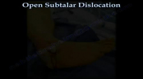 Open Subtalar Dislocation  Everything You Need To Know  Dr. Nabil Ebraheim