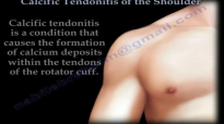 Calcific Tendonitis  Everything You Need To Know  Dr. Nabil Ebraheim
