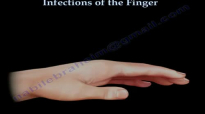Infections Of The Finger  Everything You Need To Know  Dr. Nabil Ebraheim