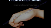 Carpometacarpal Bossing  Everything You Need To Know  Dr. Nabil Ebraheim